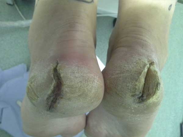 hardskin deep painful cracks at heels
