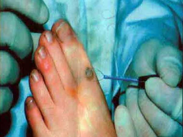 wart removed from foot using radiosurgery or electrosurgery